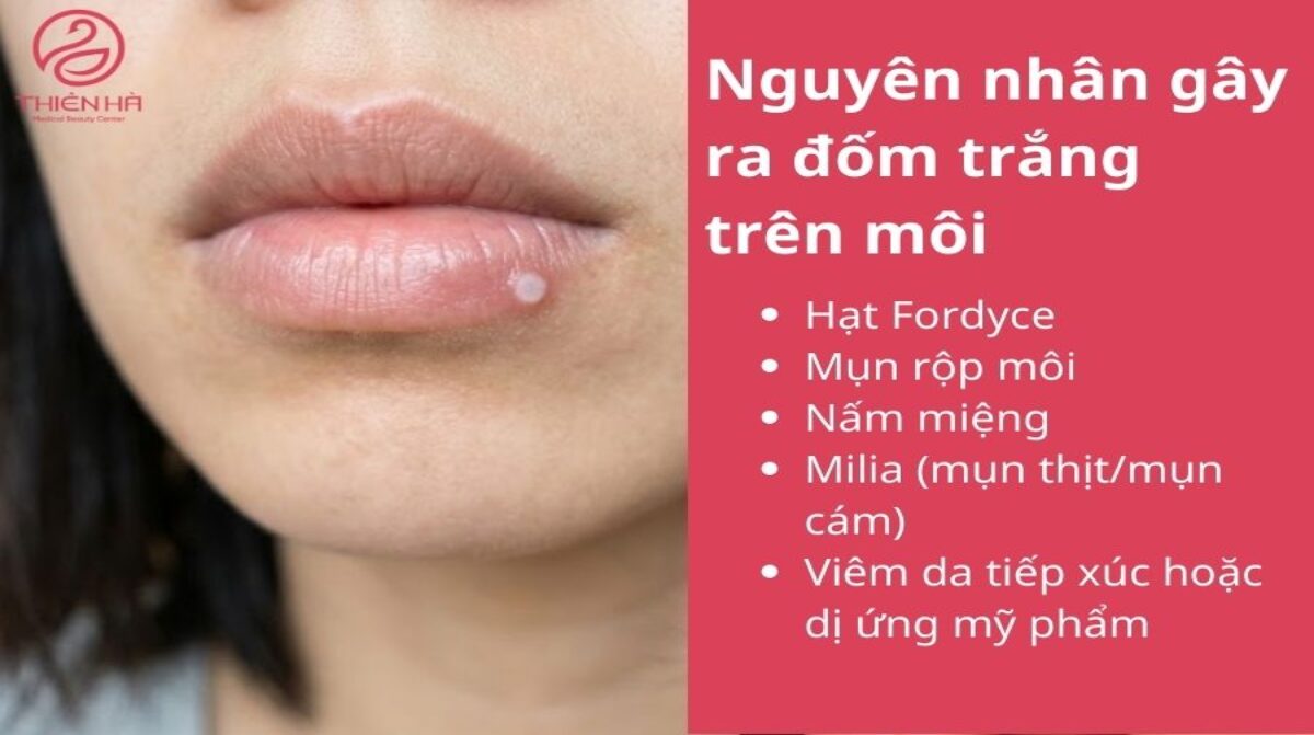Cách chữa mụn trắng ở môi an toàn theo từng nguyên nhân