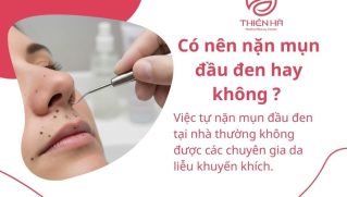 Cách nặn mụn đầu đen an toàn tại nhà: Hướng dẫn chi tiết từ chuyên gia