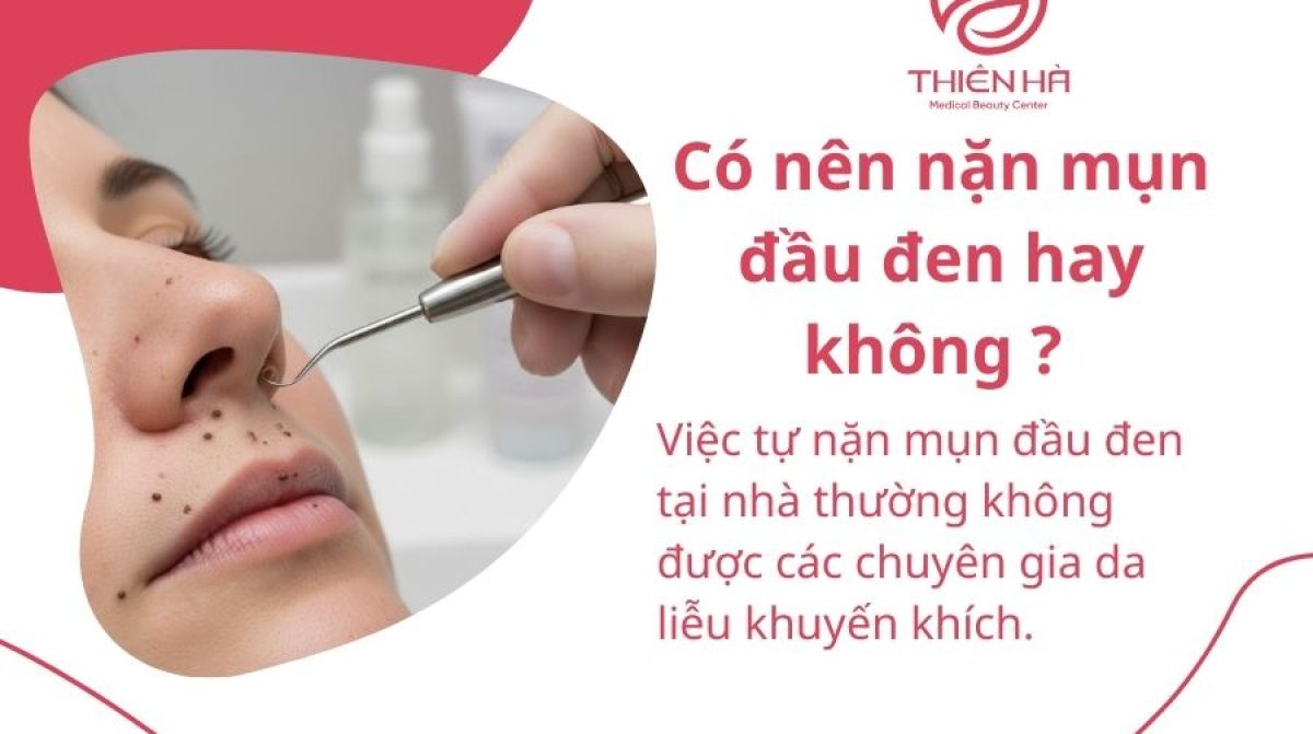 Cách nặn mụn đầu đen an toàn tại nhà: Hướng dẫn chi tiết từ chuyên gia
