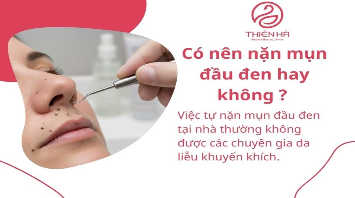 Cách nặn mụn đầu đen an toàn tại nhà: Hướng dẫn chi tiết từ chuyên gia