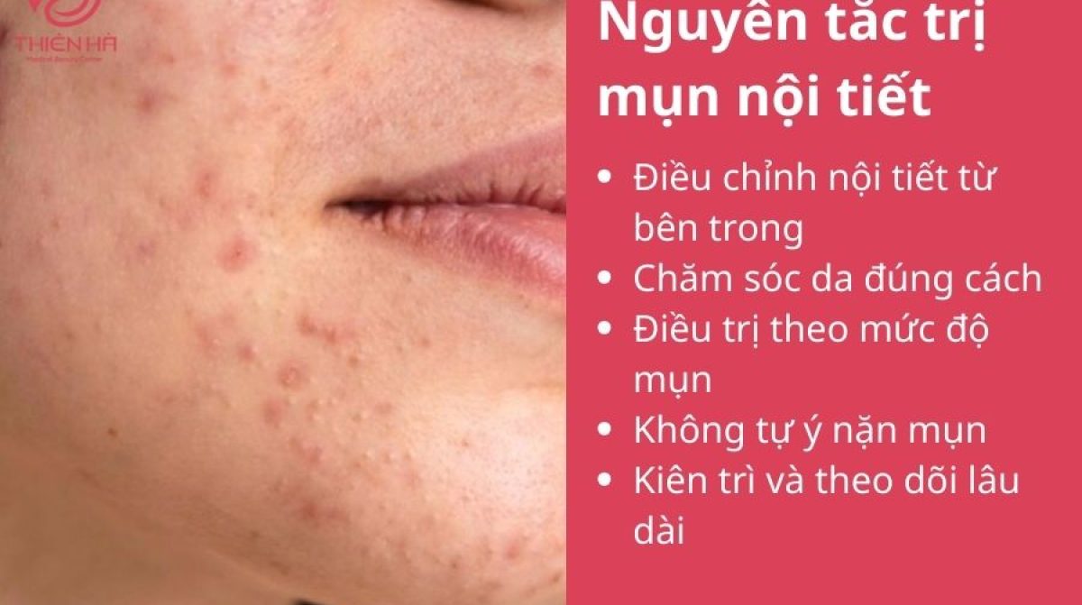 Cách trị mụn nội tiết dứt điểm: Kết hợp chăm sóc da và điều trị y khoa