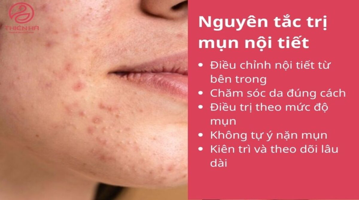 Cách trị mụn nội tiết dứt điểm: Kết hợp chăm sóc da và điều trị y khoa