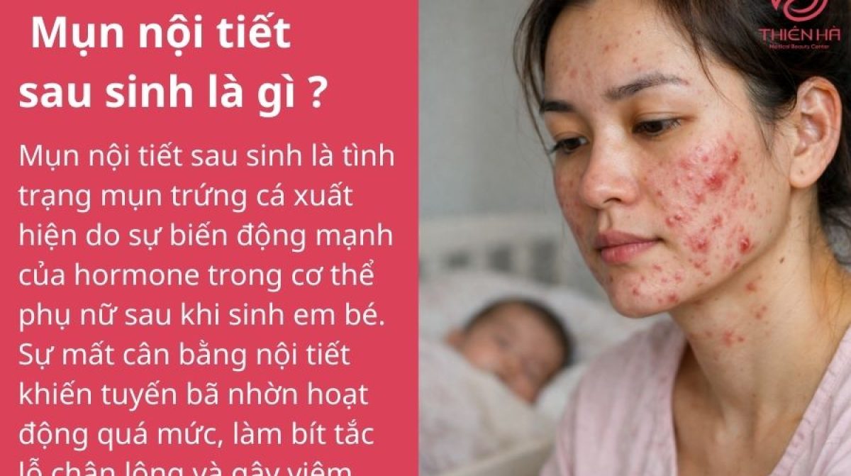 Cách trị mụn nội tiết sau sinh an toàn, hiệu quả cho mẹ bỉm