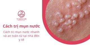 Cách trị mụn nước nhanh và an toàn từ tại nhà đến y tế