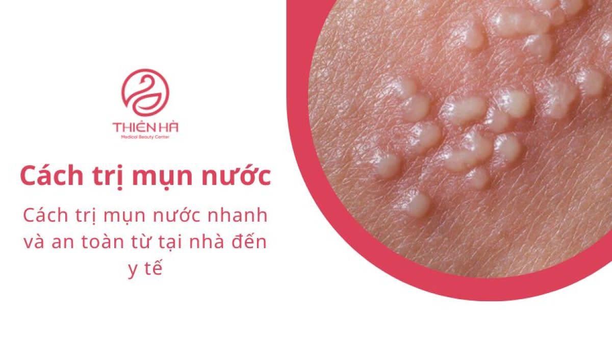 Cách trị mụn nước nhanh và an toàn từ tại nhà đến y tế