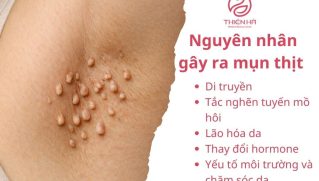 Điều trị mụn thịt hiệu quả: Laser, đốt điện, thuốc bôi và mẹo tự nhiên