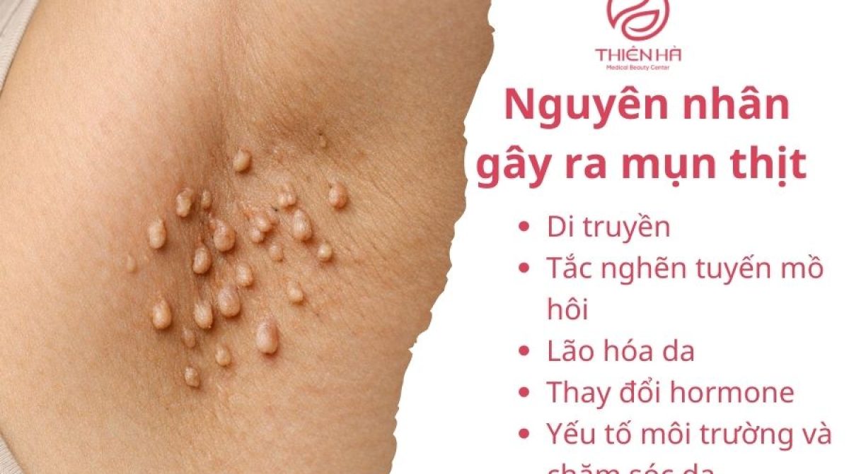 Điều trị mụn thịt hiệu quả: Laser, đốt điện, thuốc bôi và mẹo tự nhiên