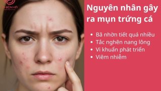 Trị mụn trứng cá tại nhà an toàn, khoa học giúp da sạch mụn, không thâm