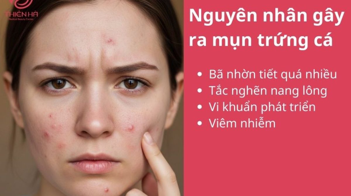 Trị mụn trứng cá tại nhà an toàn, khoa học giúp da sạch mụn, không thâm