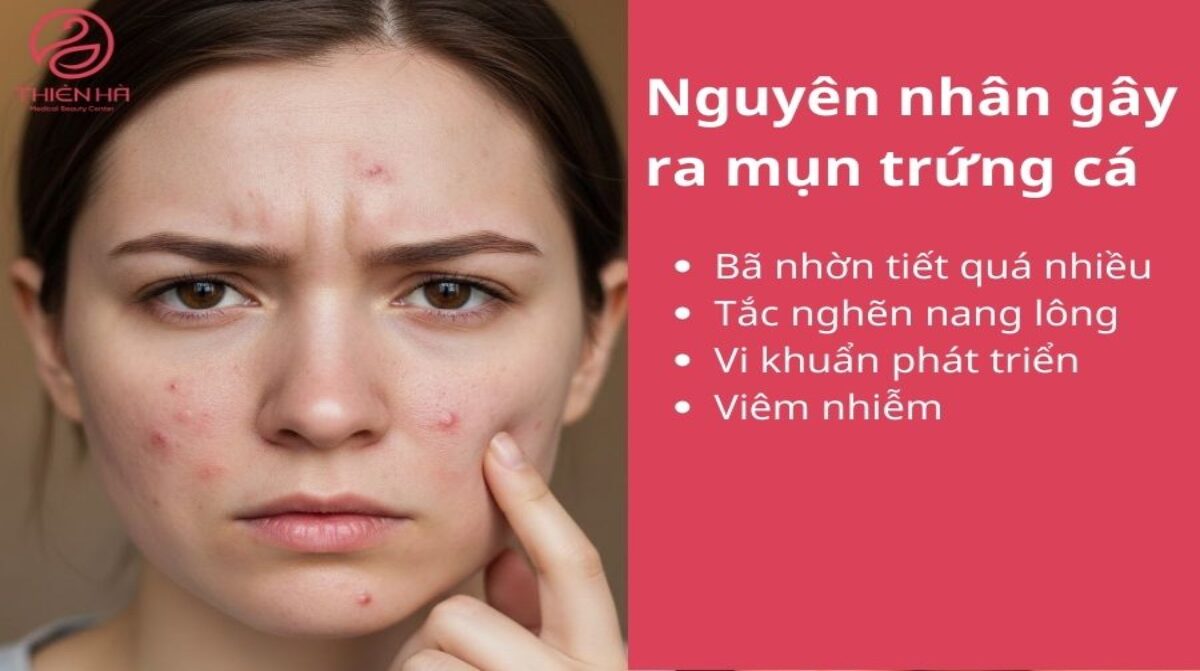 Trị mụn trứng cá tại nhà an toàn, khoa học giúp da sạch mụn, không thâm