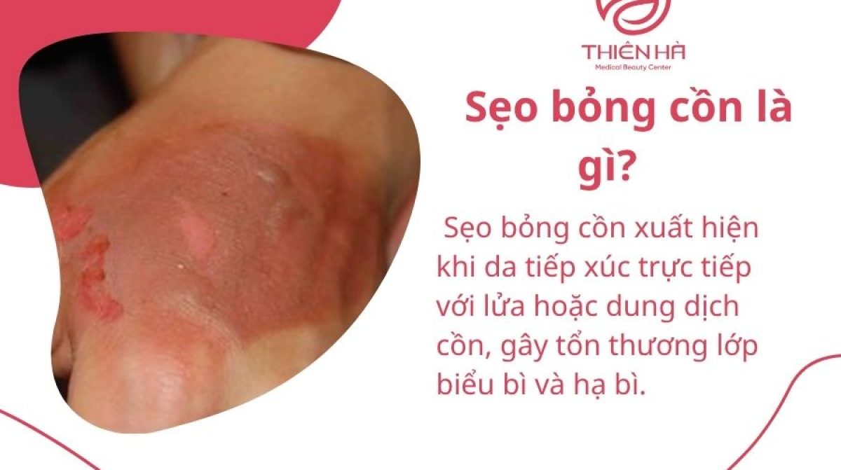 Top 10+ cách trị sẹo bỏng cồn nhanh chóng, an toàn tại nhà & spa