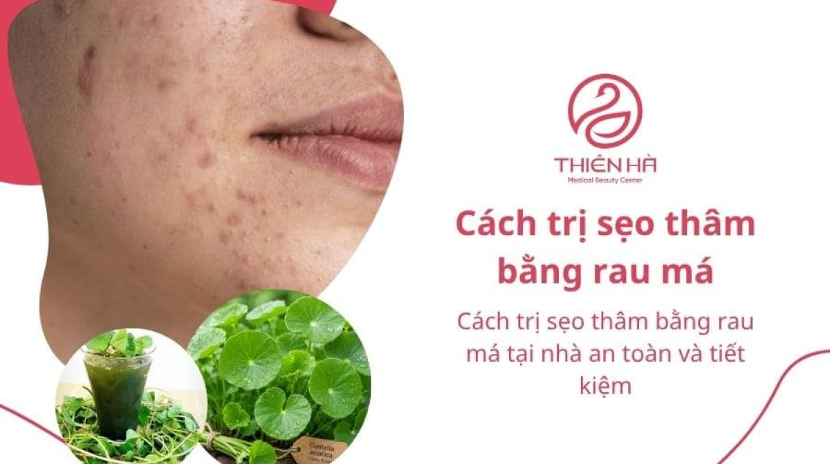 Cách trị sẹo thâm bằng rau má tại nhà an toàn và tiết kiệm