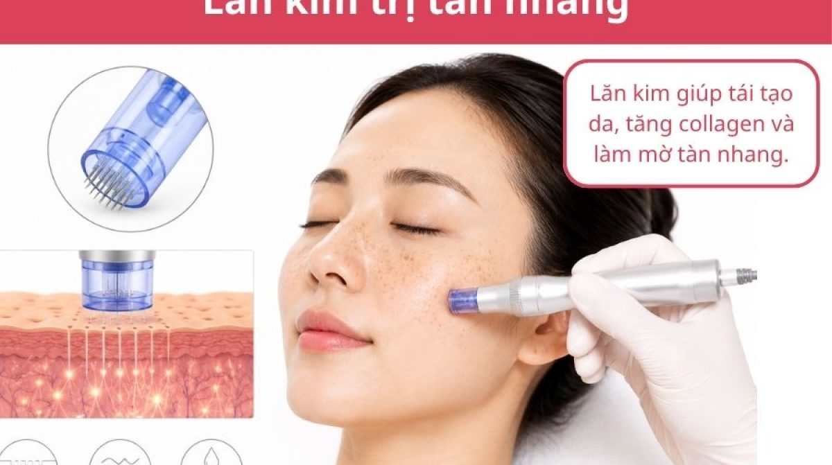 Cách trị tàn nhang hiệu quả tại nhà và công nghệ cao