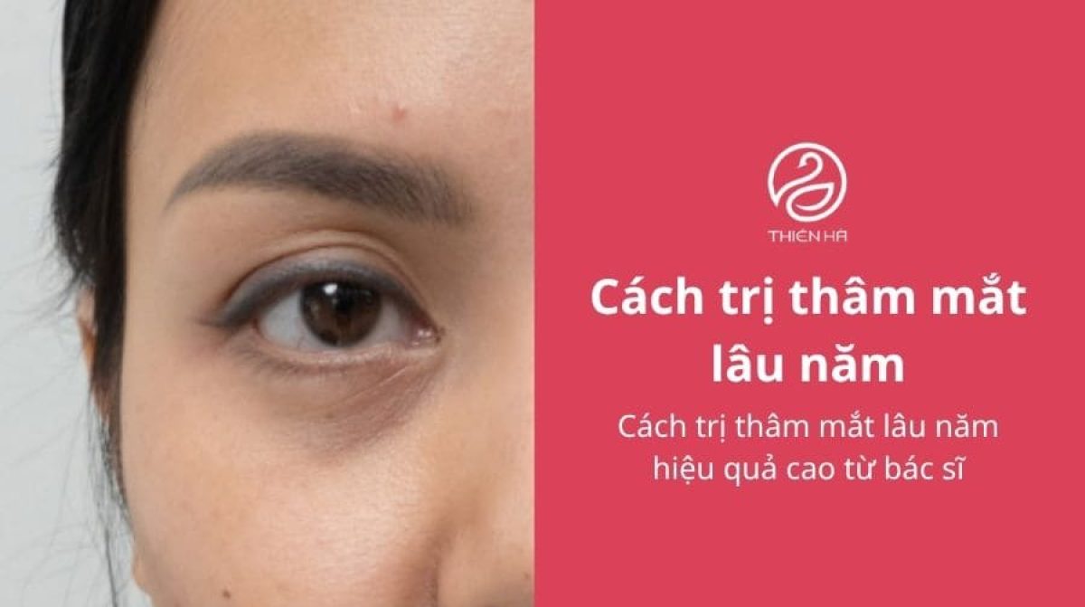 Cách trị thâm mắt lâu năm hiệu quả cao từ bác sĩ