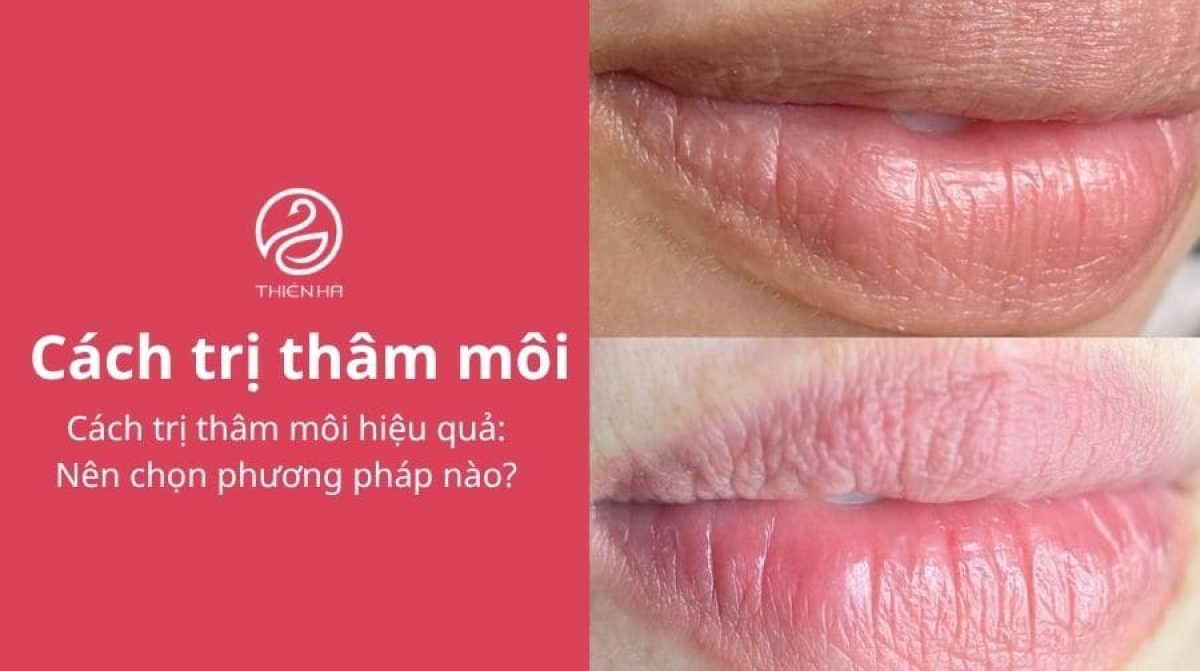 Cách trị thâm môi hiệu quả: Nên chọn phương pháp nào?