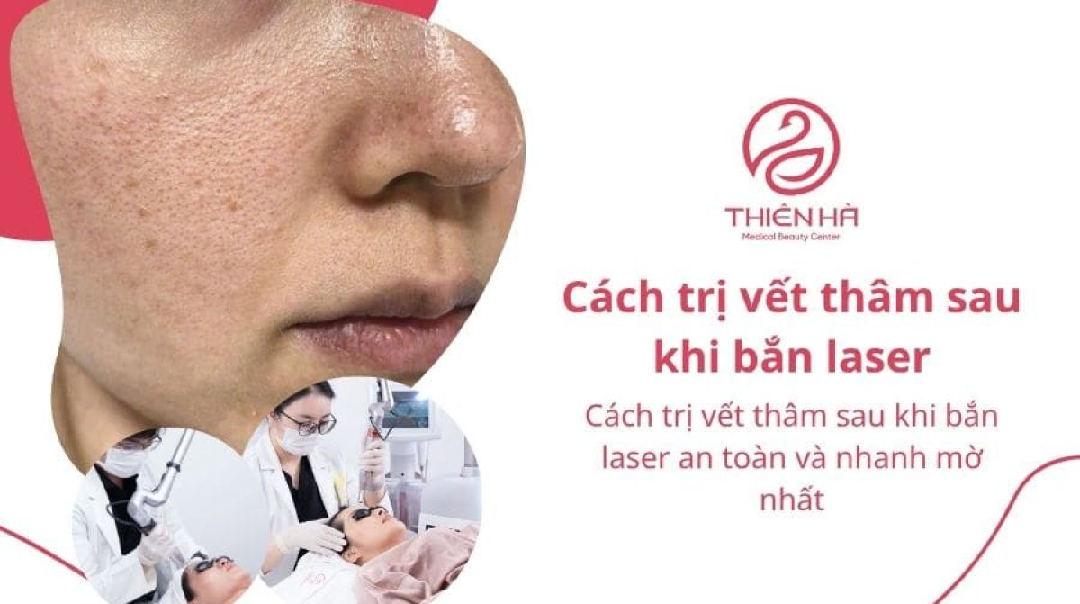 Cách trị vết thâm sau khi bắn laser giúp da phục hồi nhanh