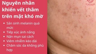 Cách trị vết thâm trên mặt nhanh nhất: Mẹo tại nhà và liệu trình chuyên sâu