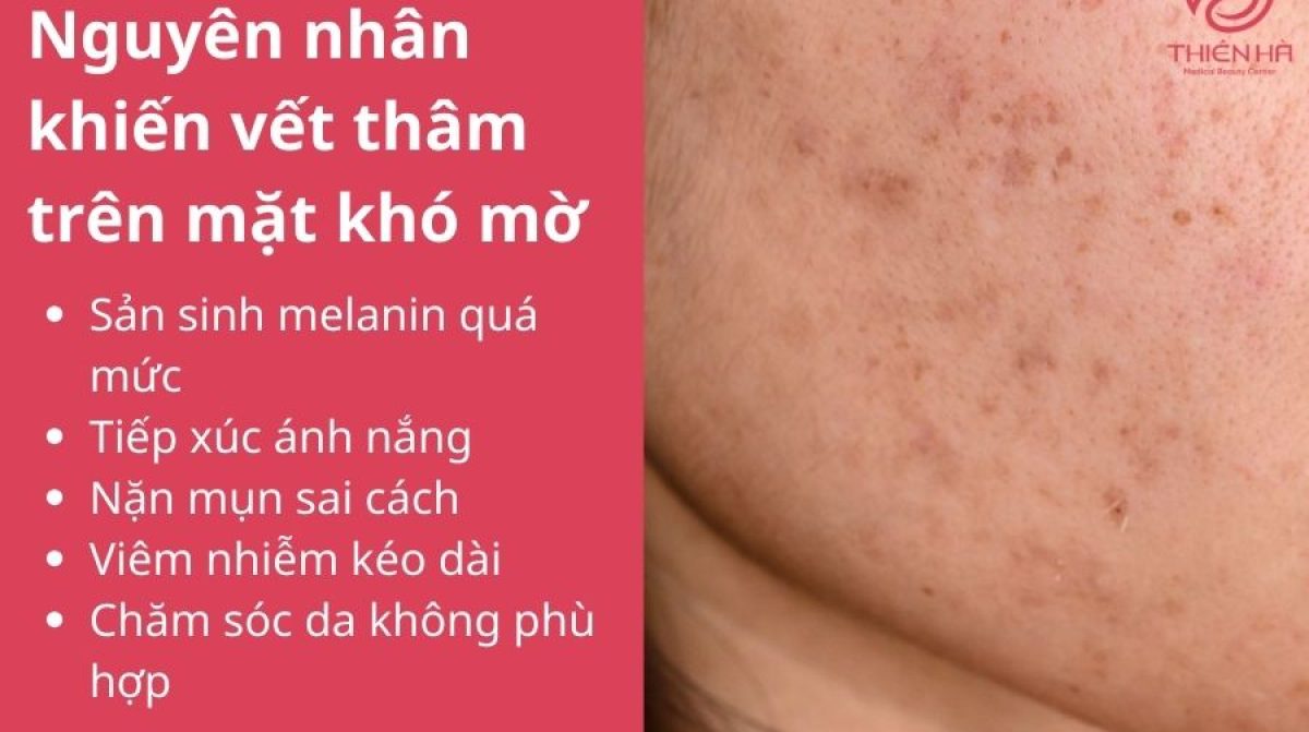 Cách trị vết thâm trên mặt nhanh nhất: Mẹo tại nhà và liệu trình chuyên sâu