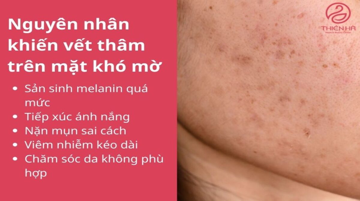Cách trị vết thâm trên mặt nhanh: Mẹo tại nhà và liệu trình chuyên sâu