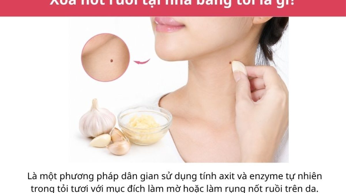 Cách xóa nốt ruồi tại nhà bằng tỏi: Hướng dẫn và lưu ý an toàn