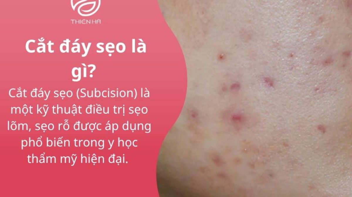 Cắt đáy sẹo: Phương pháp hiệu quả loại bỏ sẹo lõm, sẹo rỗ