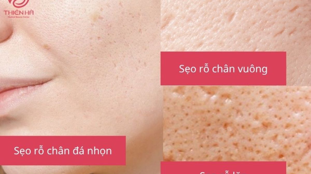 Cắt đáy sẹo rỗ giá bao nhiêu tại Hà Nội ? Thiên Hà tư vấn