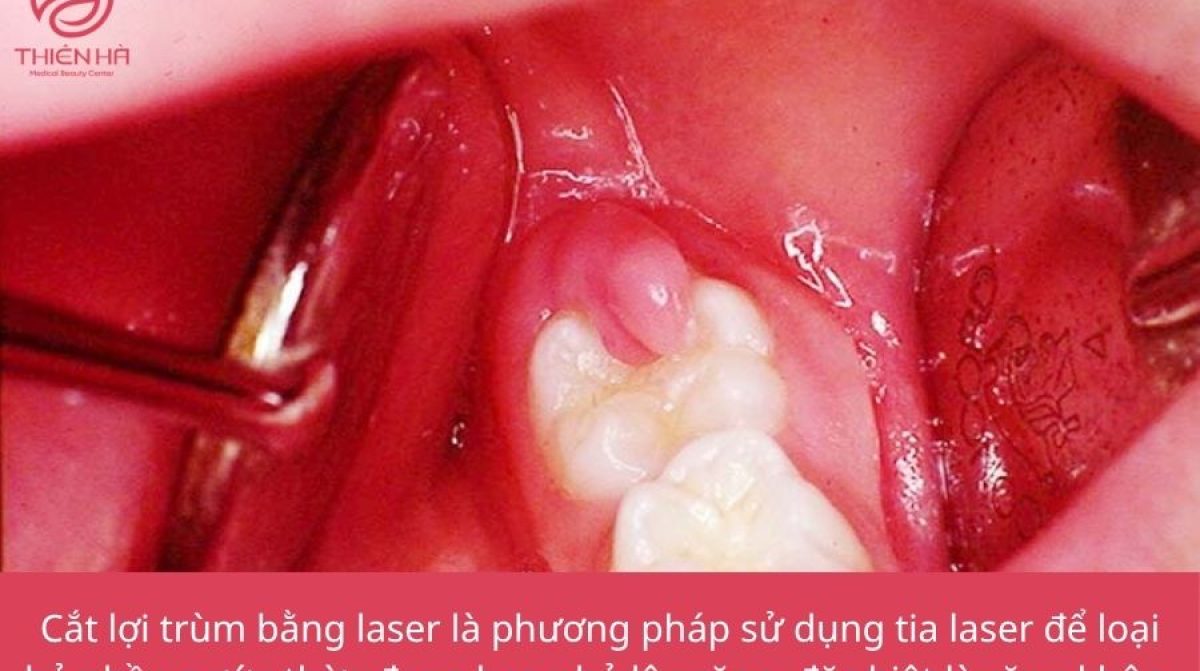 Cắt Lợi Trùm Bằng Laser Giá Bao Nhiêu? | Bảng Giá Mới Nhất