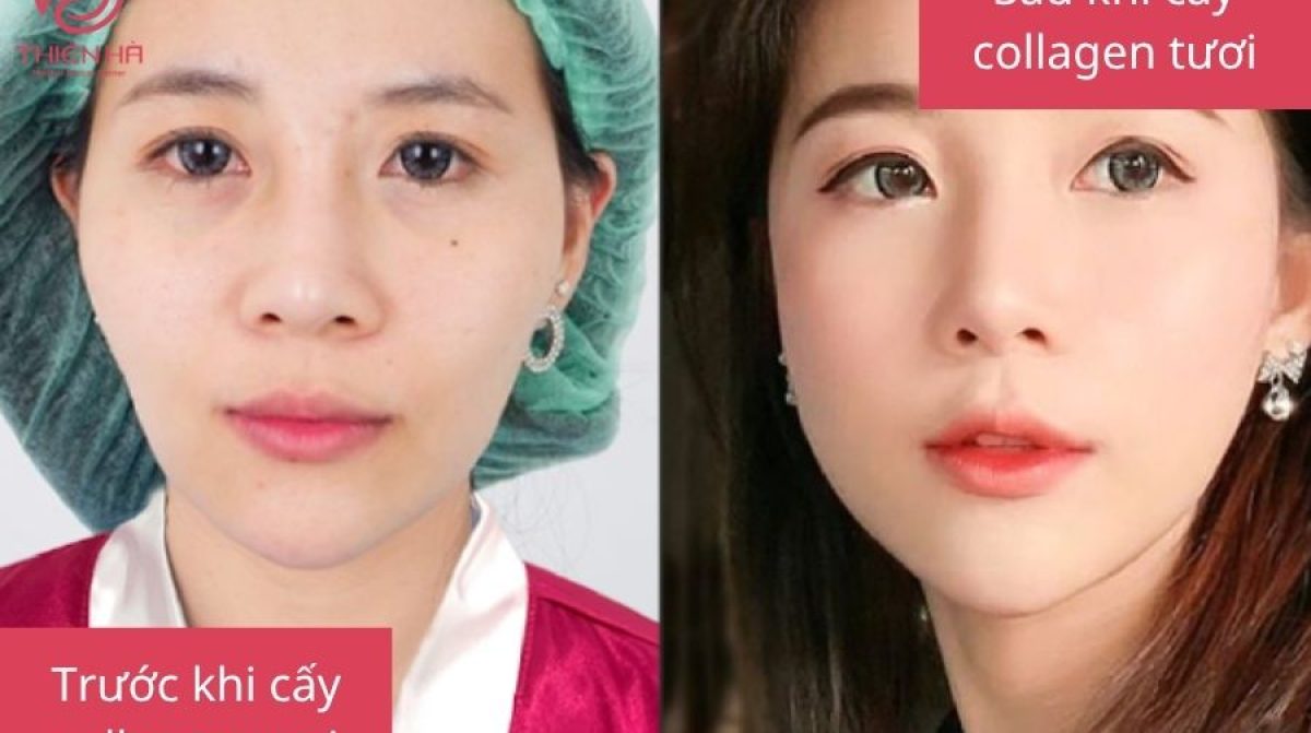 Cấy Collagen Có Tác Dụng Gì? Lợi Ích & Lưu Ý Quan Trọng