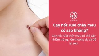 Cạy nốt ruồi chảy máu: Nguyên nhân, cách xử lý và khi nào khám