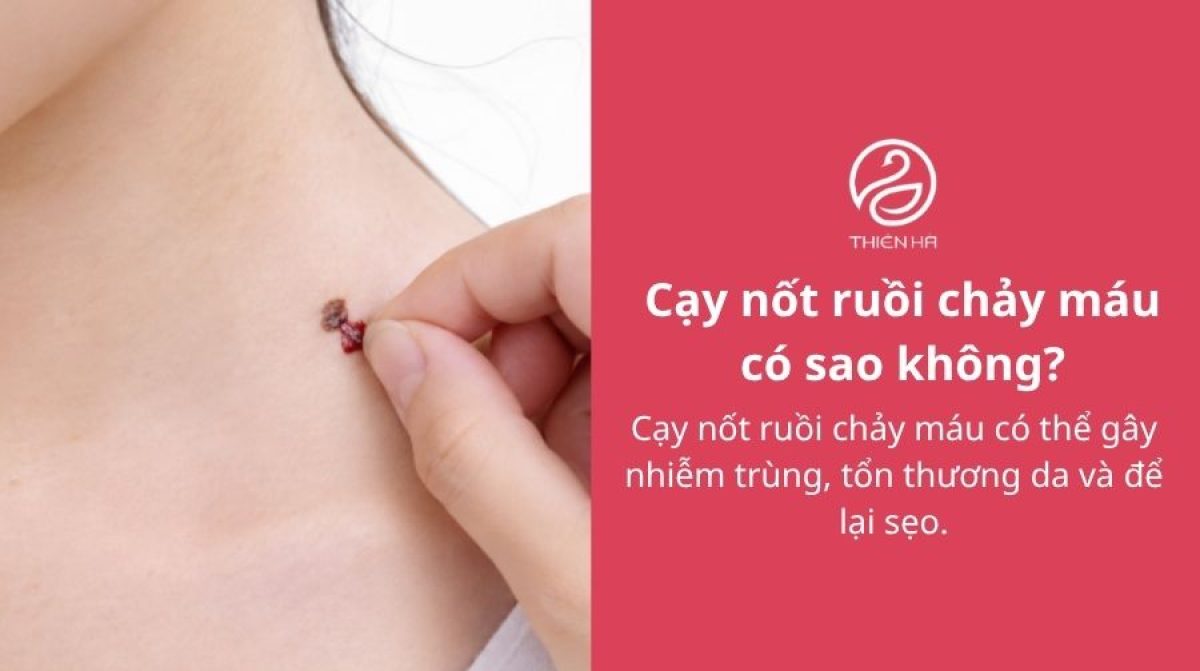 Cạy nốt ruồi chảy máu: Nguyên nhân, cách xử lý và khi nào khám