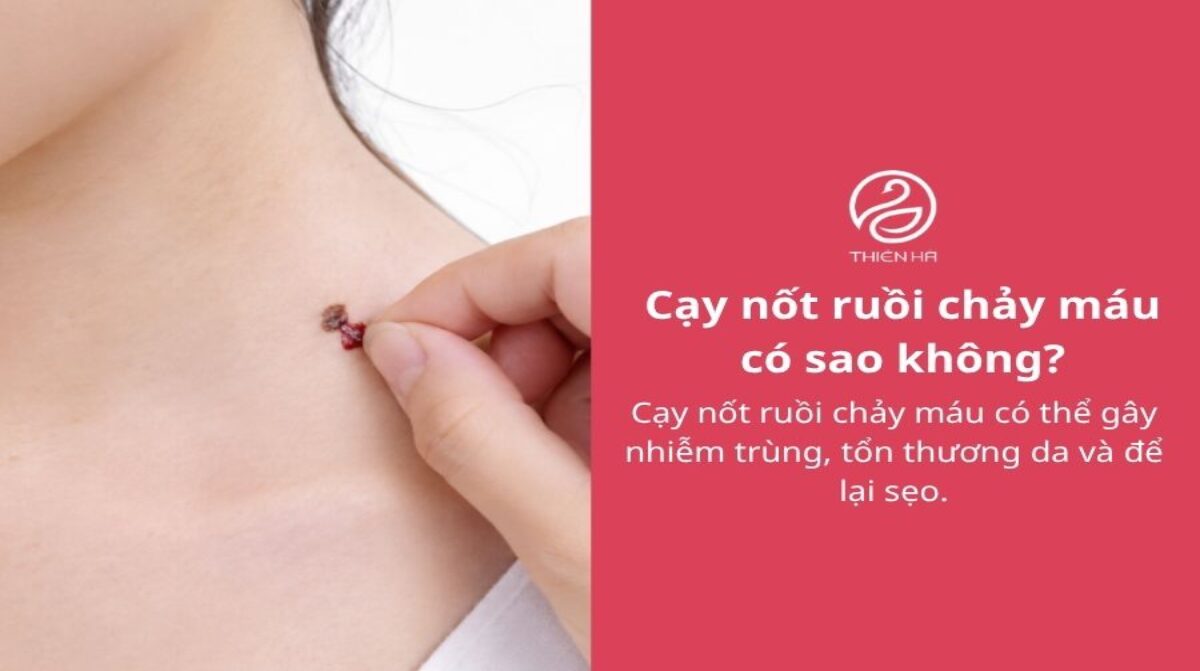 Cạy nốt ruồi chảy máu: Nguyên nhân, cách xử lý và khi nào khám