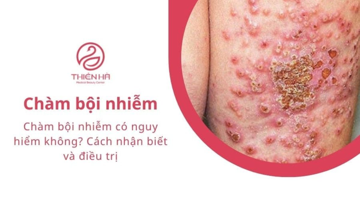 Chàm bội nhiễm có nguy hiểm không? Cách nhận biết và điều trị