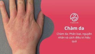 Chàm da: Phân loại, nguyên nhân và cách điều trị hiệu quả