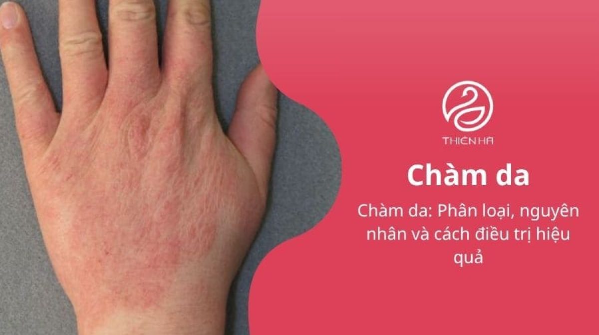 Chàm da: Phân loại, nguyên nhân và cách điều trị hiệu quả