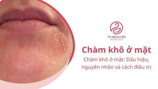 Chàm khô ở mặt: Dấu hiệu, nguyên nhân và cách điều trị