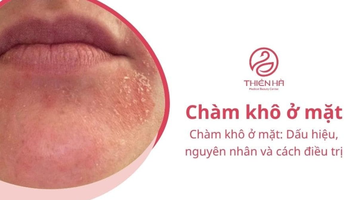 Chàm khô ở mặt: Dấu hiệu, nguyên nhân và cách điều trị