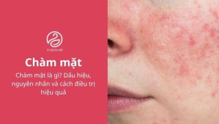 Chàm mặt là gì? Dấu hiệu, nguyên nhân và cách điều trị hiệu quả