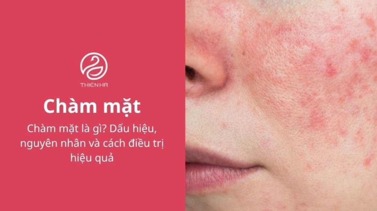 Chàm mặt là gì? Dấu hiệu, nguyên nhân và cách điều trị hiệu quả