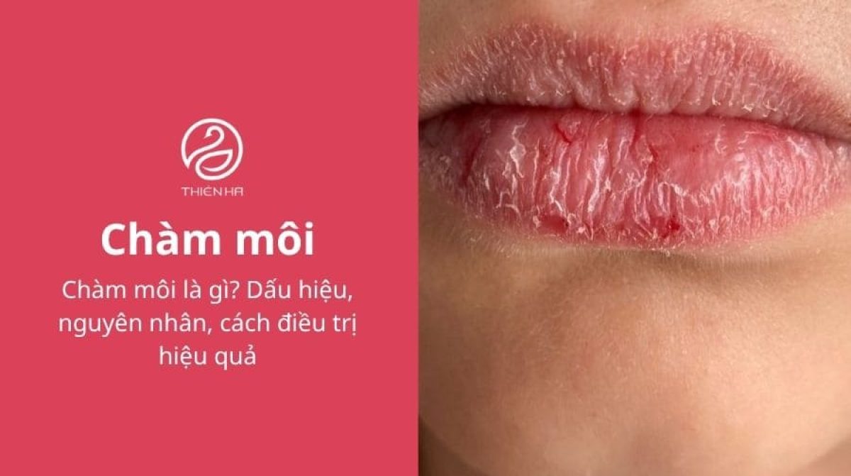 Chàm môi là gì? Dấu hiệu, nguyên nhân, cách điều trị hiệu quả