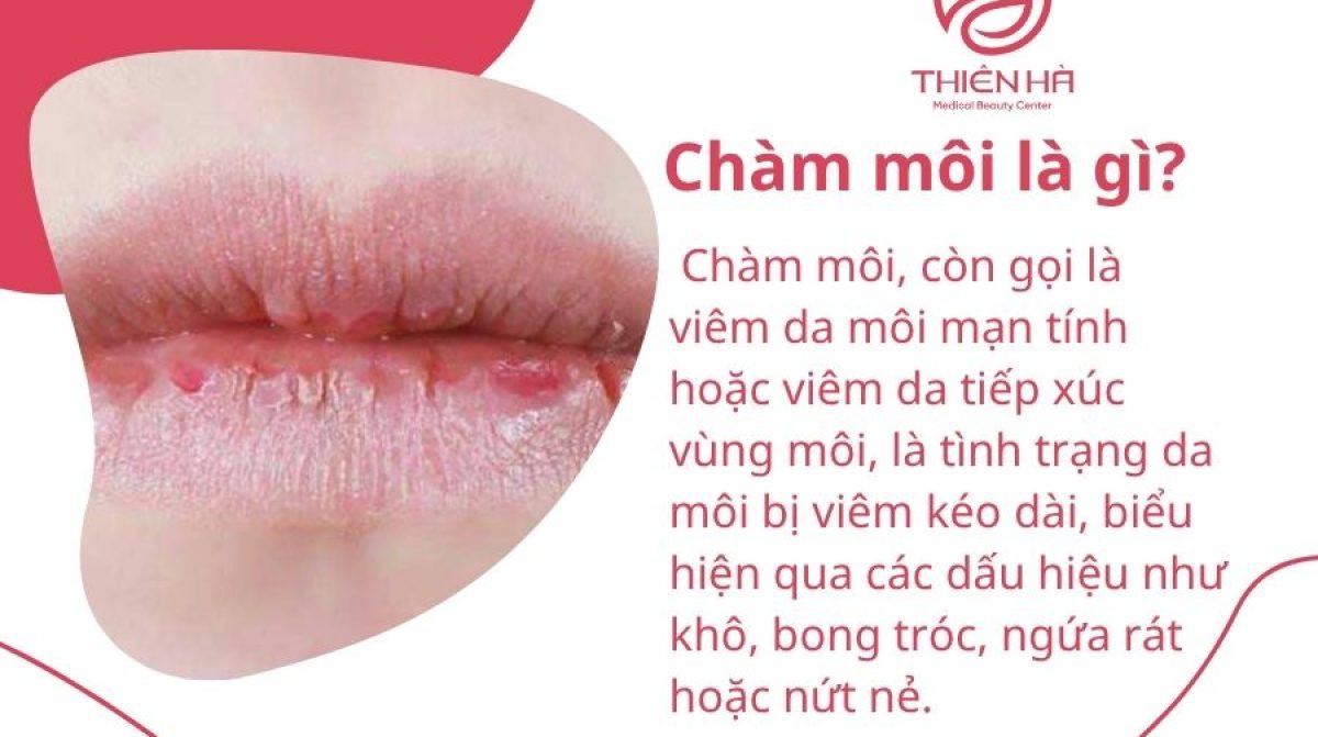 Chàm môi là gì? Nguyên nhân, dấu hiệu và cách điều trị hiệu quả