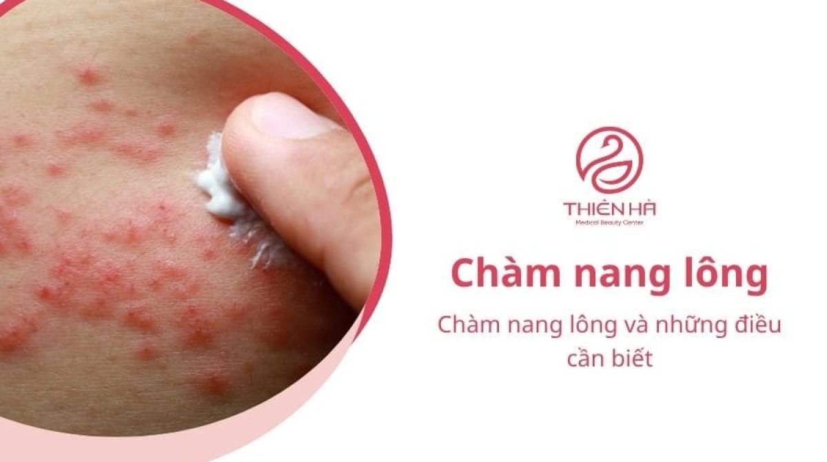 Chàm nang lông và những điều cần biết