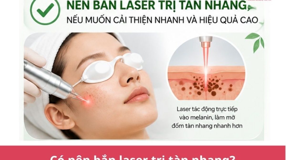 Có nên bắn laser trị tàn nhang? Ưu nhược điểm cần biết