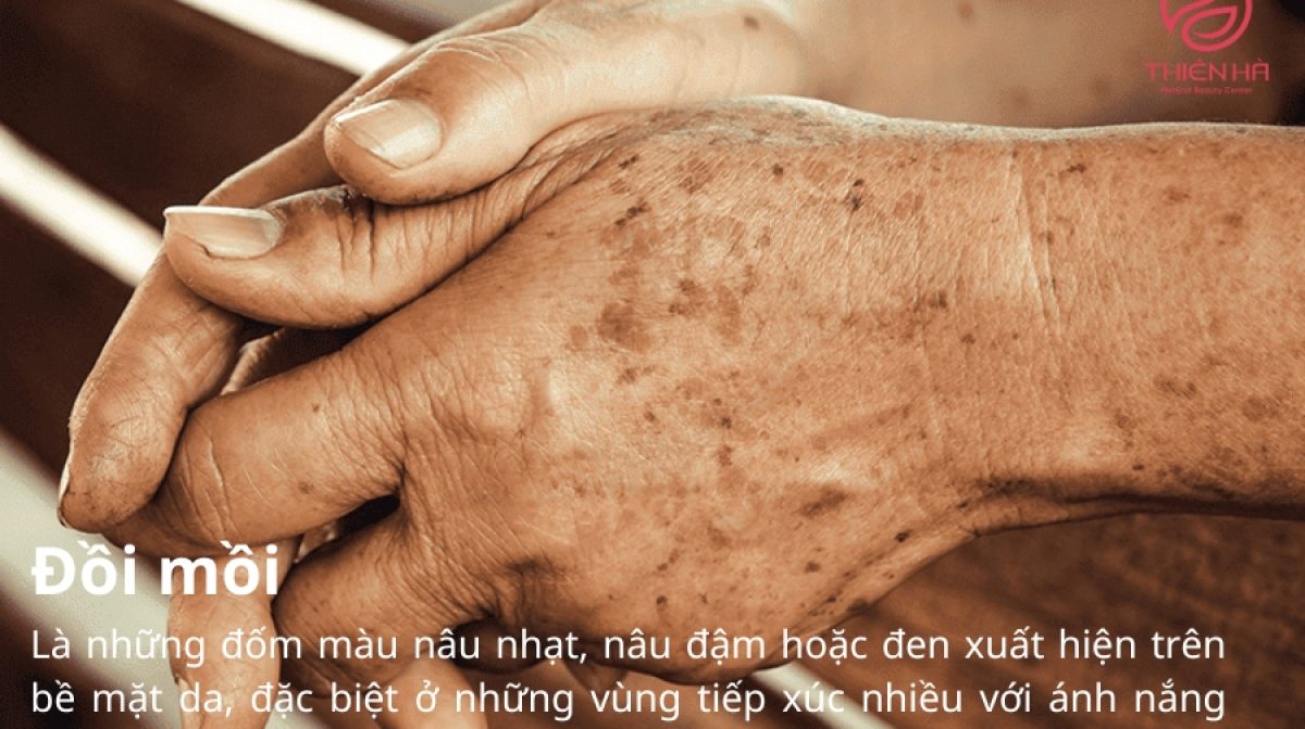 Hiểu đúng về đồi mồi và cách chăm sóc da đúng cách