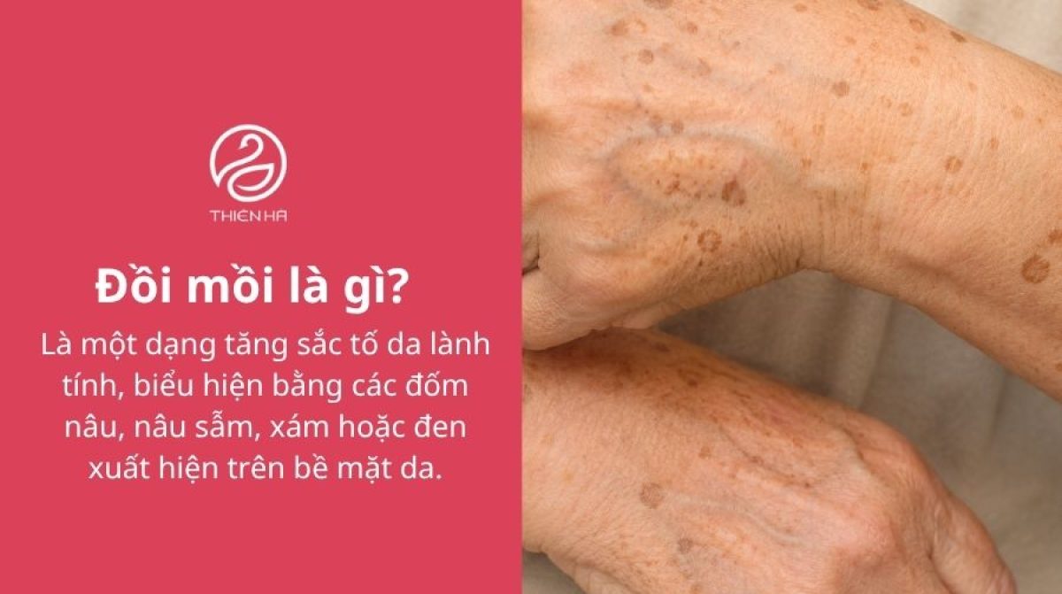 Đồi mồi là gì? Có nguy hiểm không và cách xử lý hiệu quả