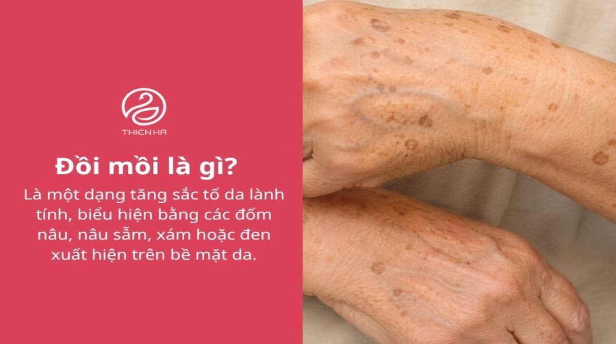 Đồi mồi là gì? Có nguy hiểm không và cách xử lý hiệu quả