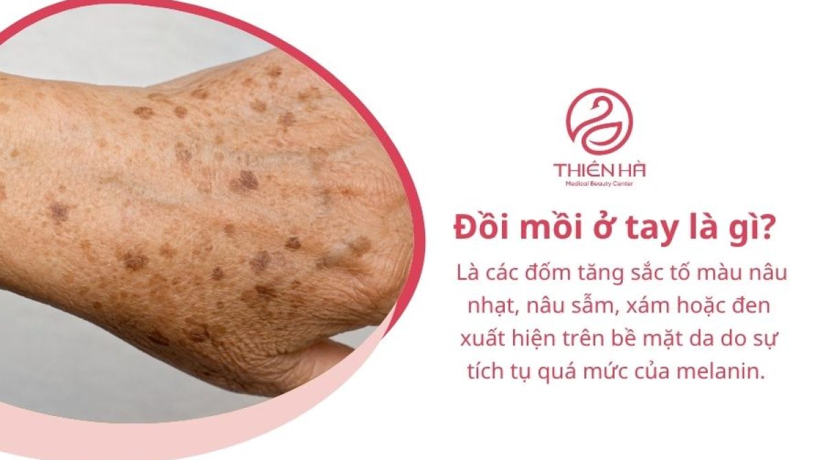 Đồi mồi ở tay: Nguyên nhân, có nguy hiểm không, cách trị