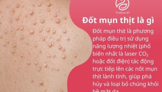 Đốt mụn thịt là gì? Khi nào nên đốt để tránh thâm sẹo