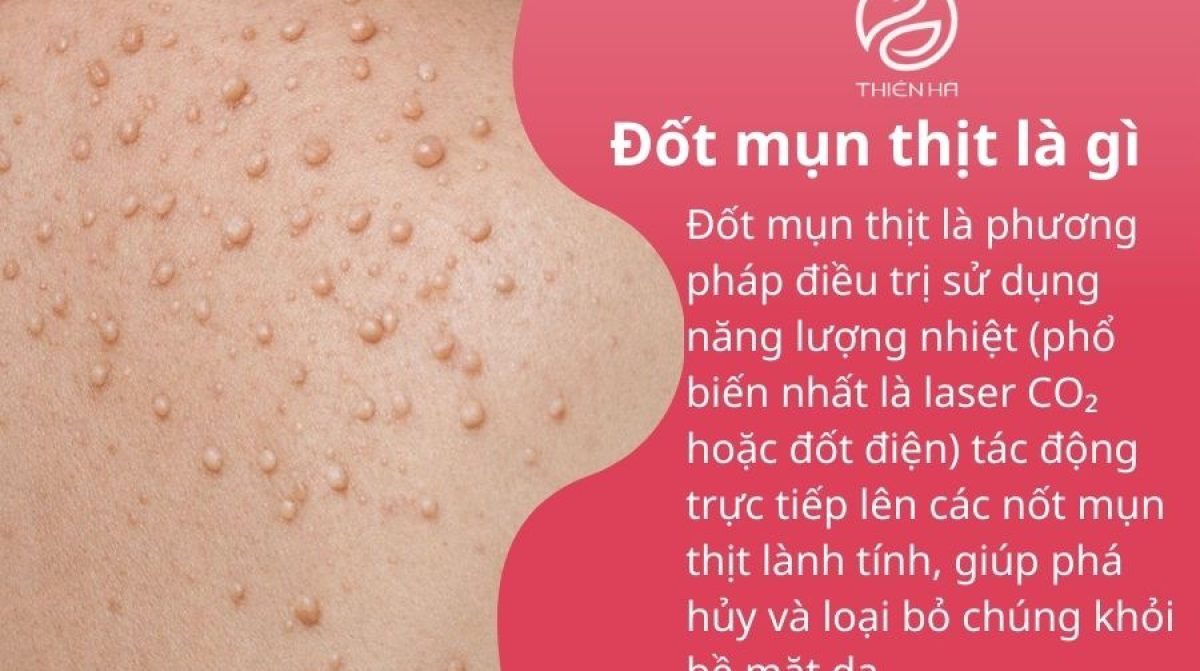 Đốt mụn thịt là gì? Khi nào nên đốt để tránh thâm sẹo