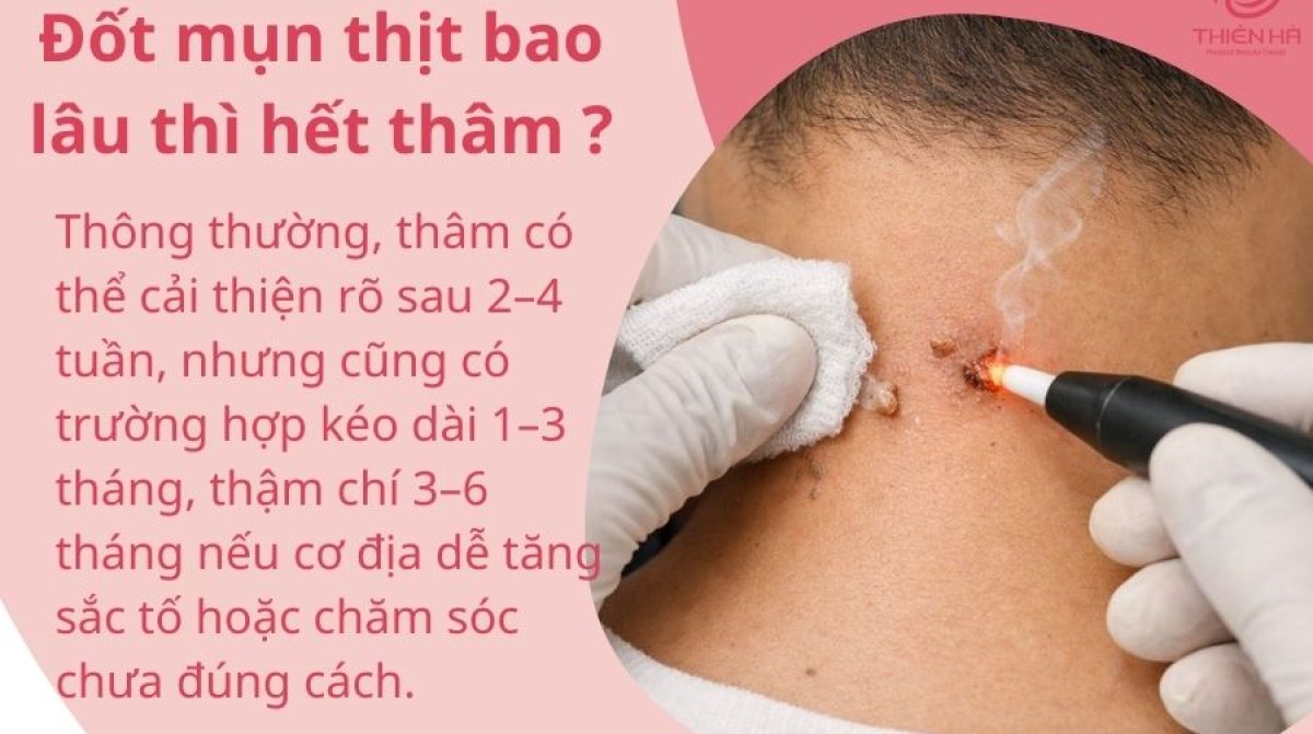 Đốt mụn thịt bao lâu thì hết thâm? Thời gian phục hồi và chăm sóc da