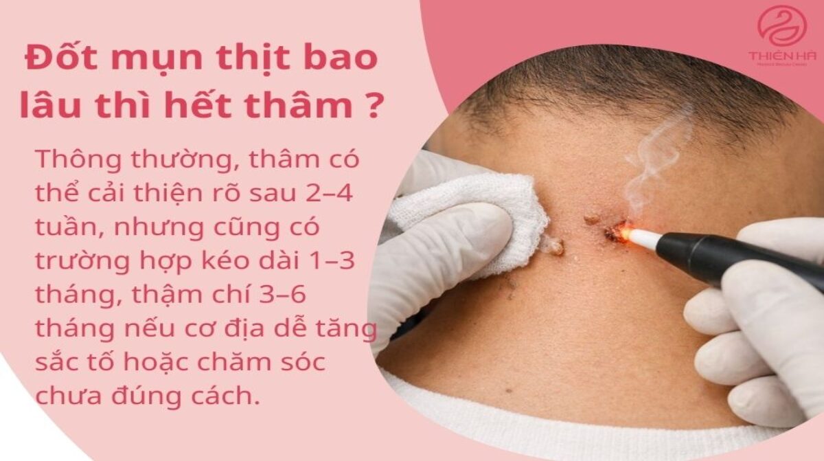 Đốt mụn thịt bao lâu thì hết thâm? Thời gian phục hồi và chăm sóc da